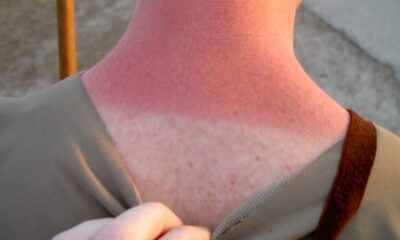 Солнечный ожог