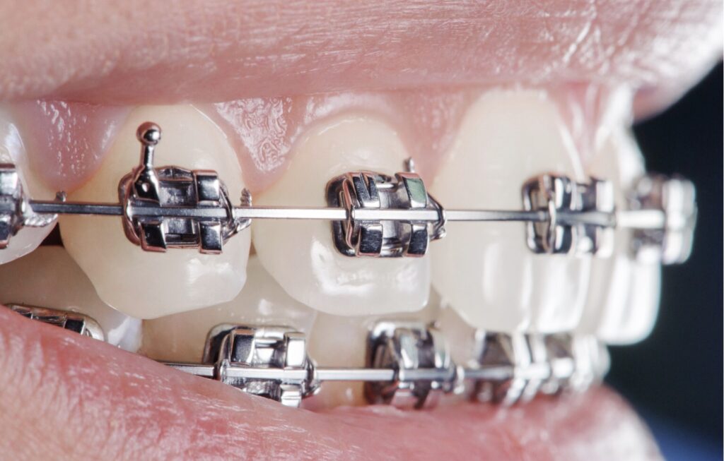 Установка брекетов