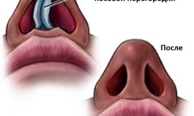 Искривление носовой перегородки