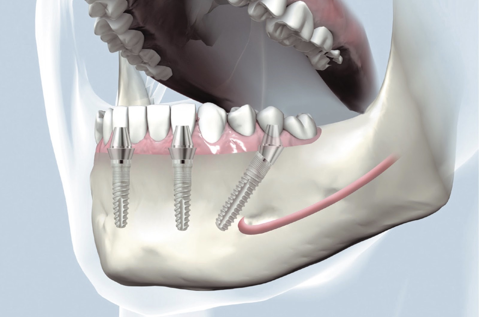 Имплантация системой Ankylos. Имплант Ankylos c1. Импланты Ankylos (Германия). Имплантация челюсти на 4 имплантах. Зубы импланты поэтапно