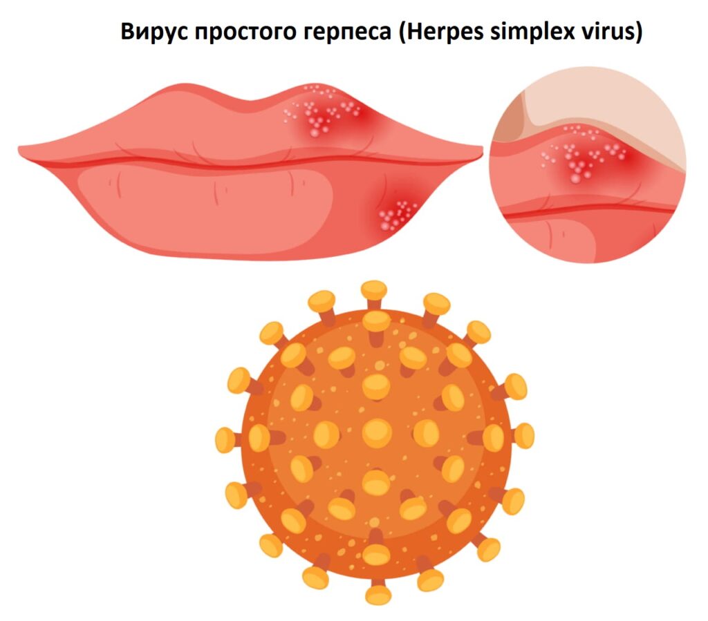 Вирус простого герпеса (Herpes simplex virus)
