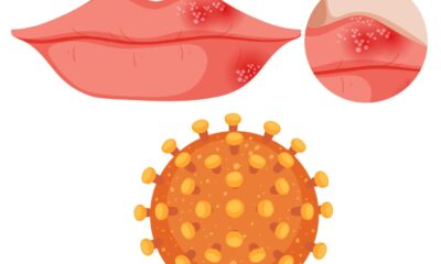 Вирус простого герпеса (Herpes simplex virus)