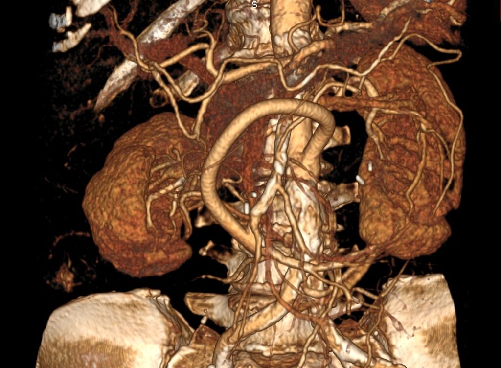 Протез сосуда на послеоперационном томографическом снимке