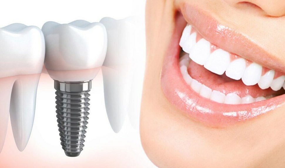 Имплантация зубов