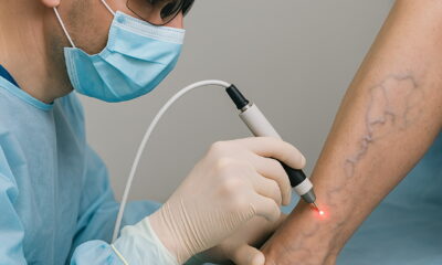 Лазерное удаление вен на ногах