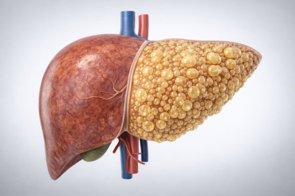 Визуализация печени человека с жировой инфильтрацией