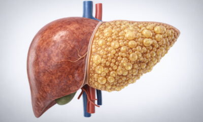 Визуализация печени человека с жировой инфильтрацией