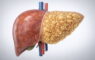 Визуализация печени человека с жировой инфильтрацией
