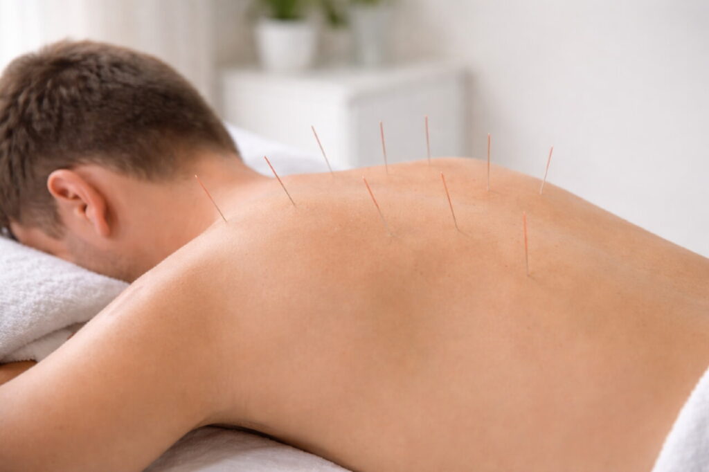 Сеанс иглотерапии