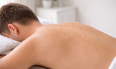 Сеанс иглотерапии