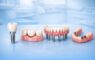 Какие зубные протезы самые лучшие и удобные