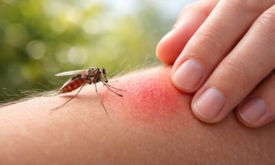 Комар на тёплой коже человека