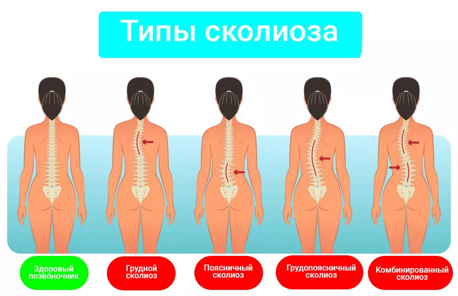 Неравномерное положение плеч