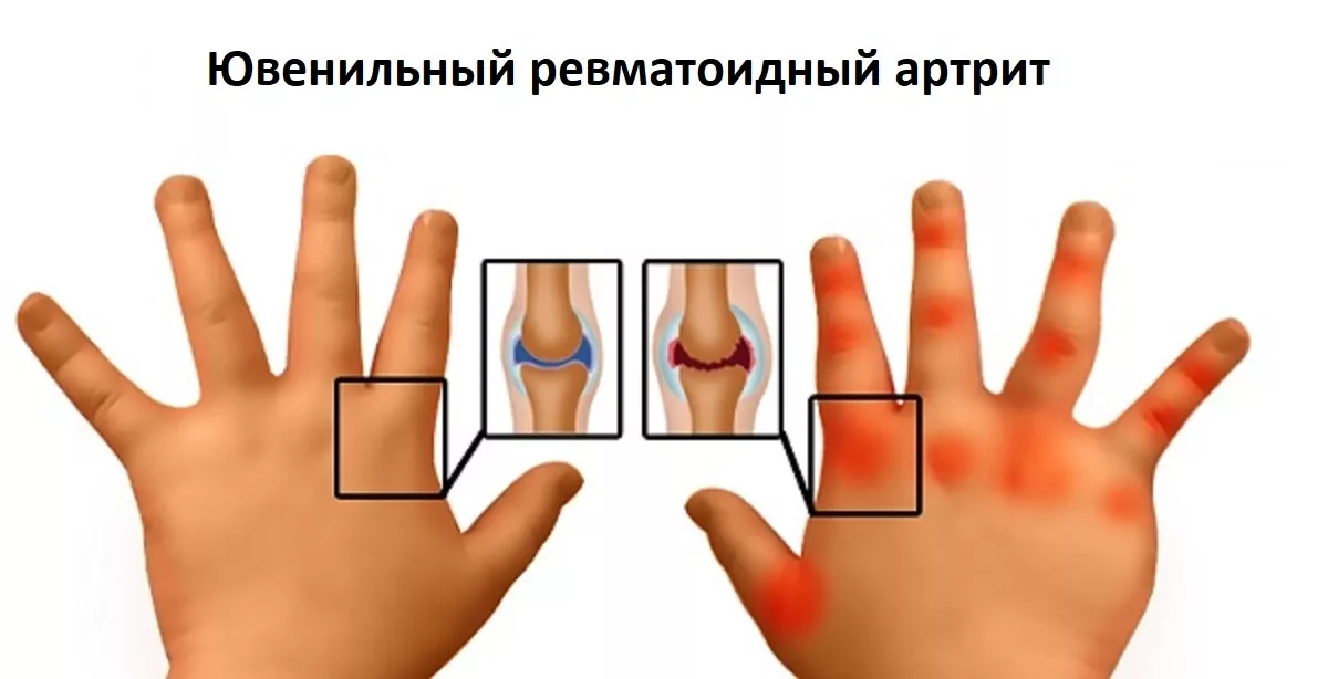 Ювенильный ревматоидный артрит