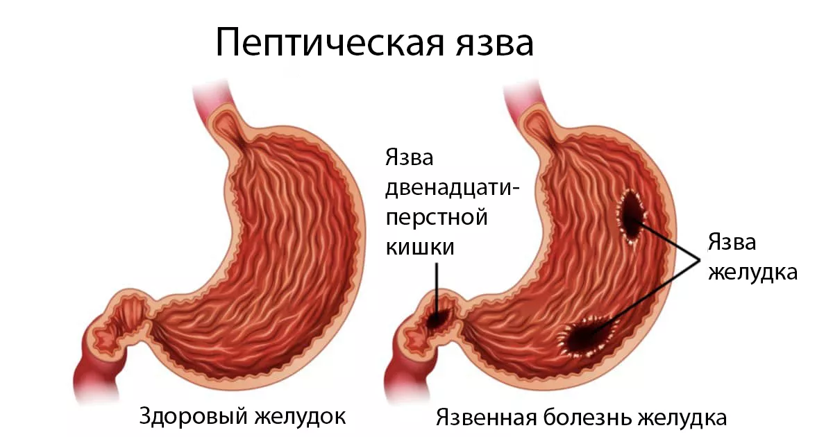 Пептическая язва