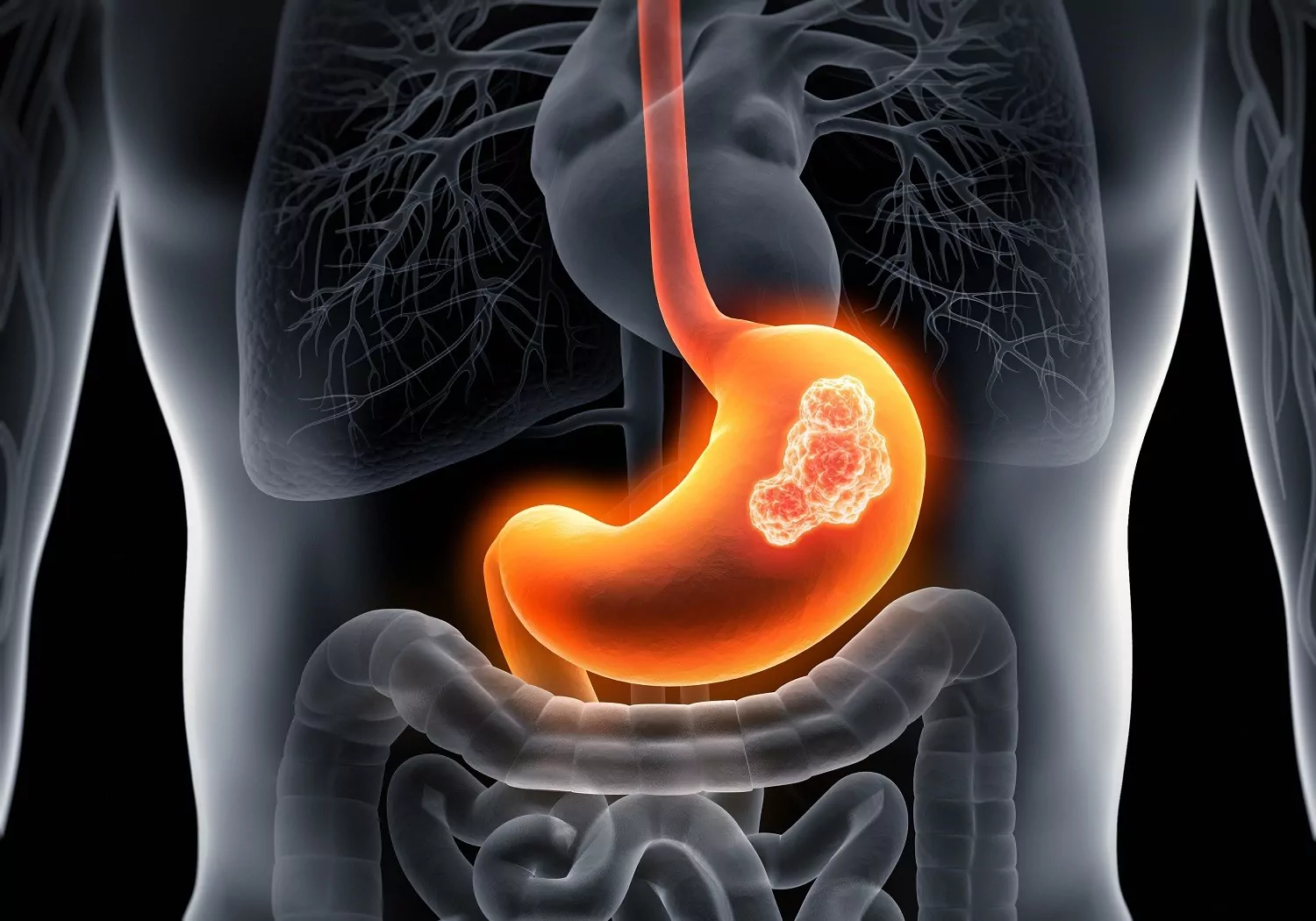 Helicobacter pylori, курение, нитраты провоцируют рак желудка
