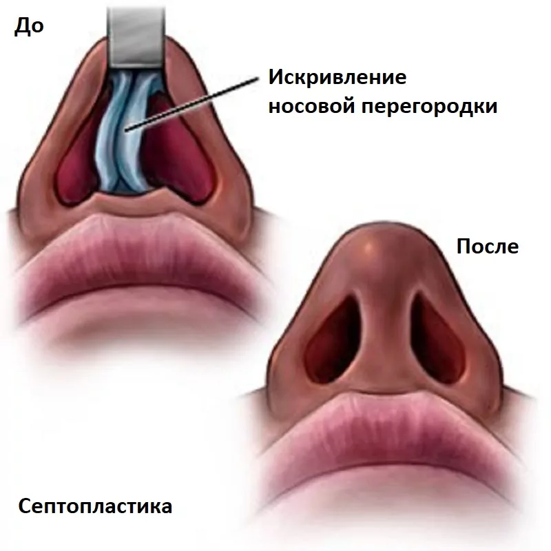 Искривление носовой перегородки