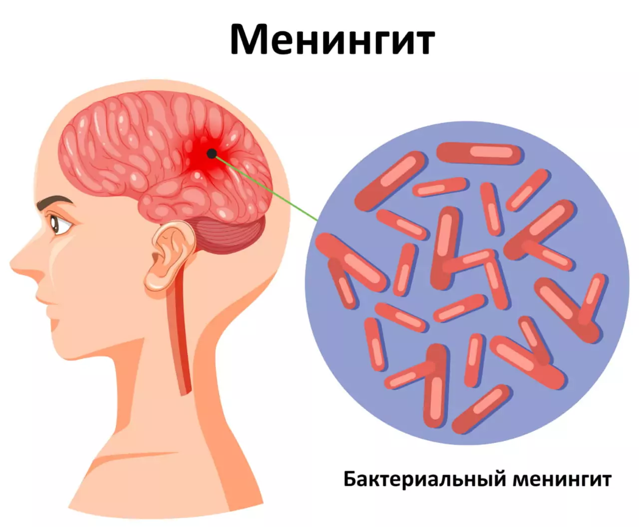 Долгожитель менингит: многовековая биография жизнеугрожающей болезни