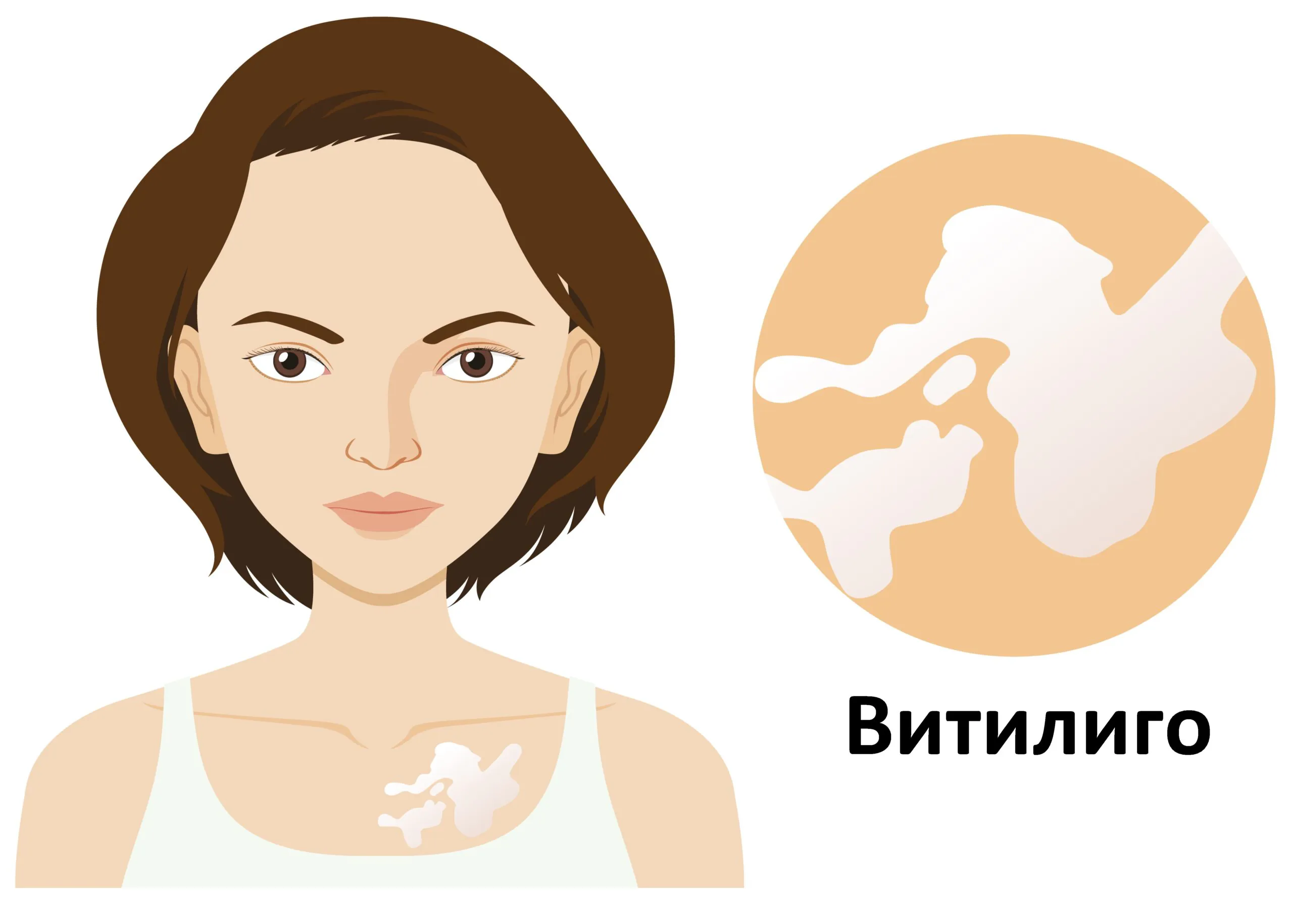 Белые пятна на коже: что такое Витилиго